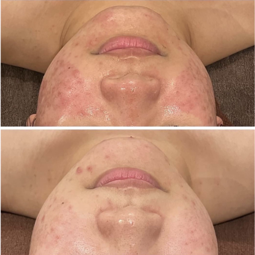 【ニキビケア人気No.1】肌トラブル完全ケア繰り返すニキビ予防にオススメ◎