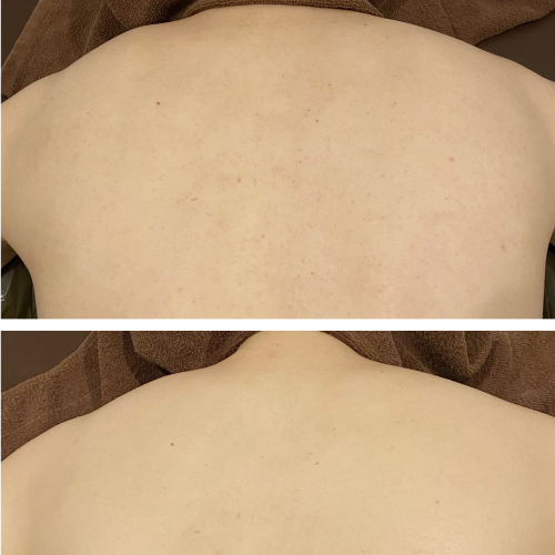 あなたも背中美人に!ニキビケア/シミ/ざらつき/毛穴改善★背中ハ-ブピ-リング