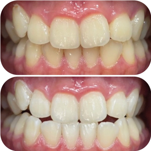 短時間で歯が白く♪今人気のセルフホワイトニング☆(8分×2回)
