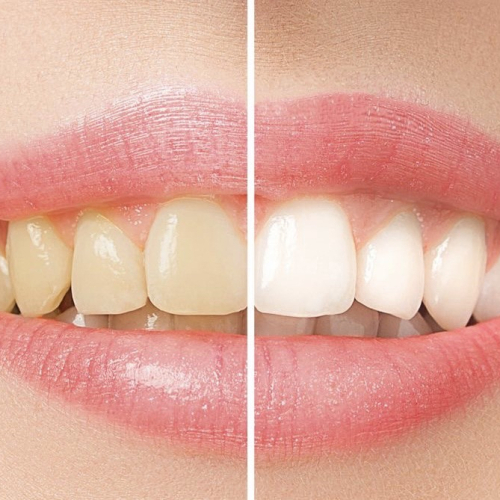 ★脱マスク前に！キレイな白い歯セルフホワイトニング【 通いたい放題☆】