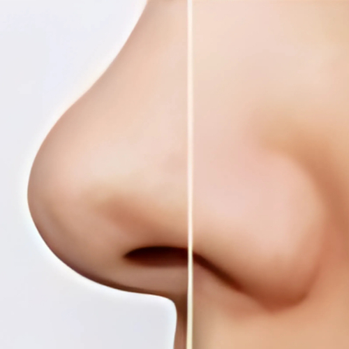 【お得♪小顔×毛穴洗浄】春休みCP♪毛穴洗浄+ハイパーナイフ引き締め小顔★